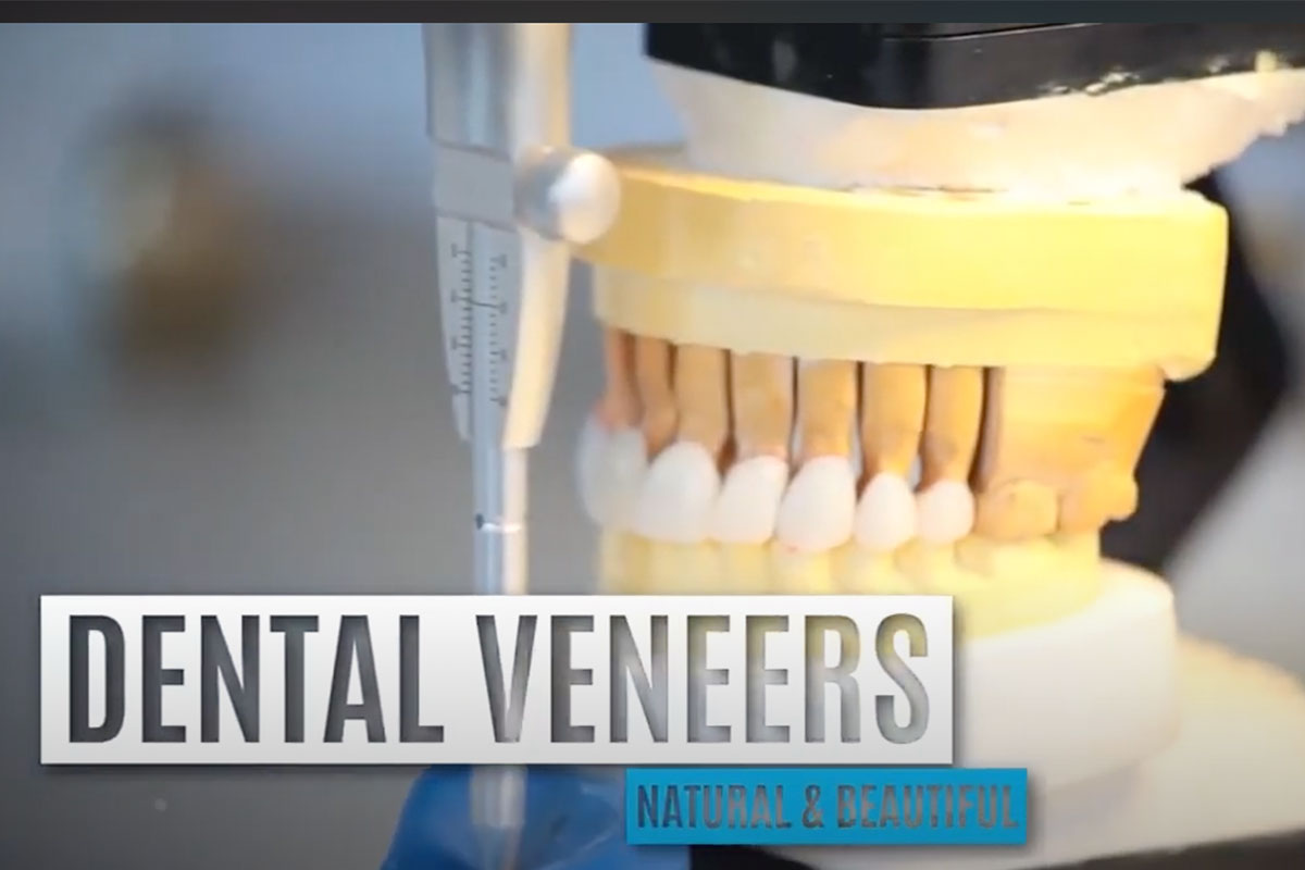 veneers in Los Feliz